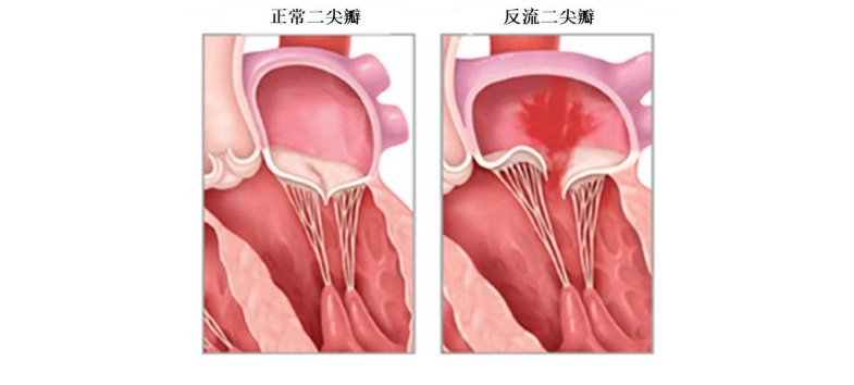 對標雅培，國產二尖瓣獨角獸沖刺科創(chuàng)板