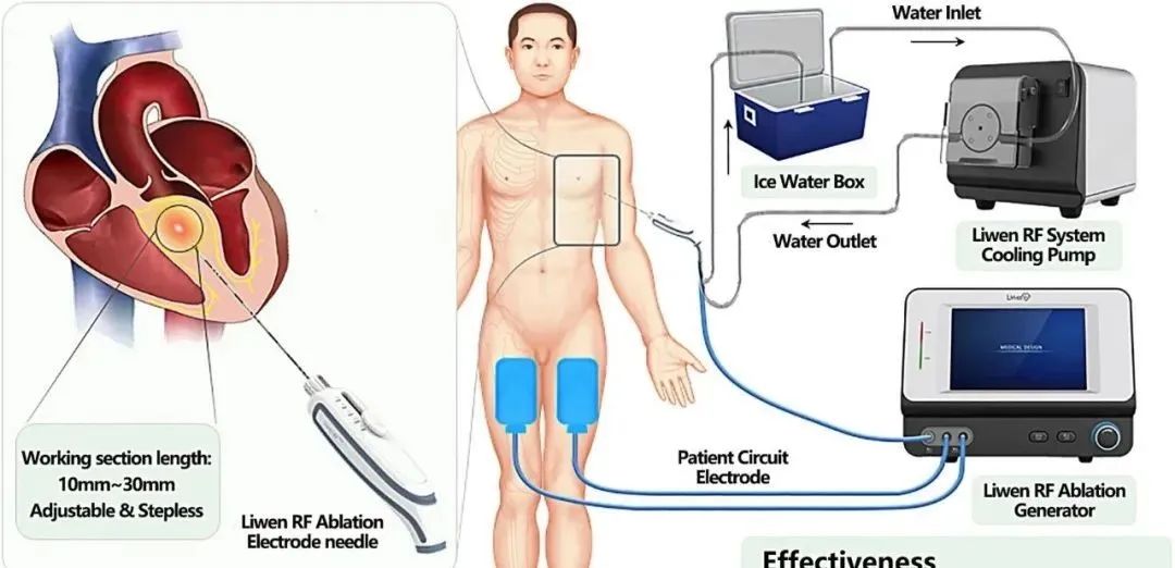 Liwen：肥厚型心肌病射頻療法完成注冊臨床入組
